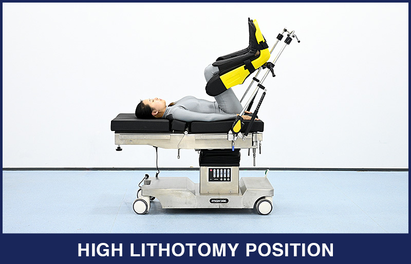 The Introduction of Lithotomy Position