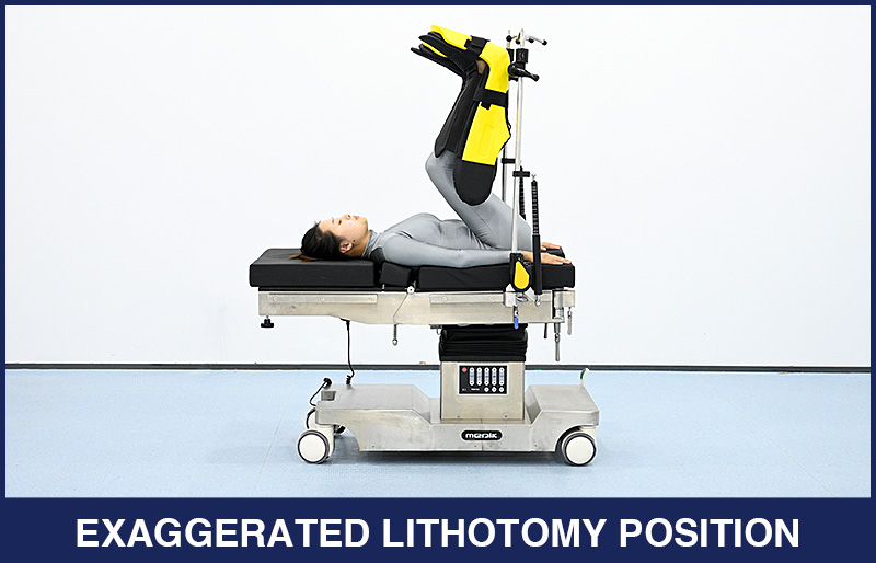 The Introduction of Lithotomy Position