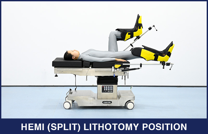 The Introduction of Lithotomy Position