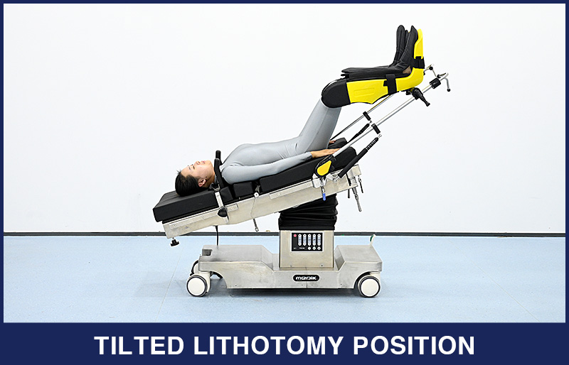 The Introduction of Lithotomy Position